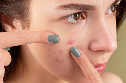 How to Treat Hormonal Acne at Home - DIY tips that actually work!